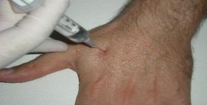 Effetti collaterali in agopuntura omeopatica
