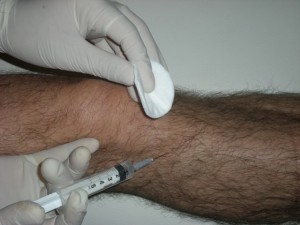 Artrosi del ginocchio e agopuntura