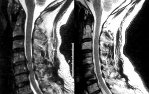  come curare la cervicale con agopuntura